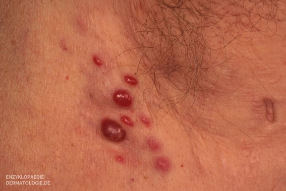 Diese Bild zeigt eine Ansammlung von Merkelzellkarzinomen