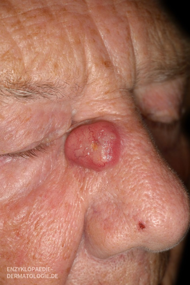 Dieses Bild zeigt ein Merkelzellkarzinom am Auge des Patienten