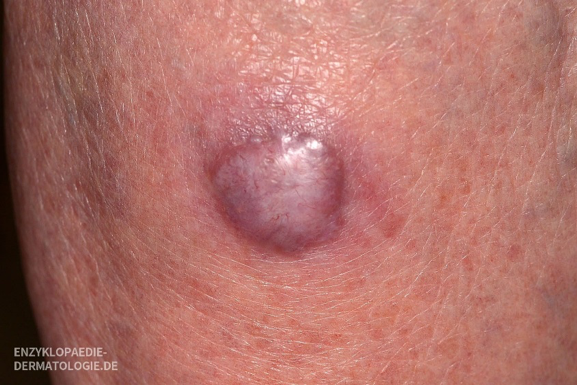 Diese Bild zeigt eine weitere Nahaufnahme eines Merkelzellkarzinoms