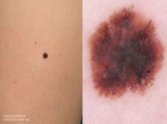 Diese Bild zeigt den schwarzen Hautkrebs (Melanom) in seinem Anfangsstadium