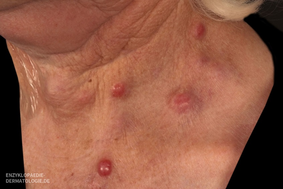 Diese Bild zeigt das Merkelzellkarzinom am Hals des Patienten